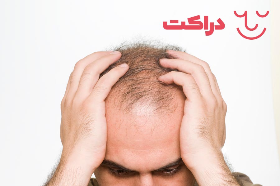ماینوکسیدیل برای همه افراد با مشکل موی جدی قابل استفاده است.