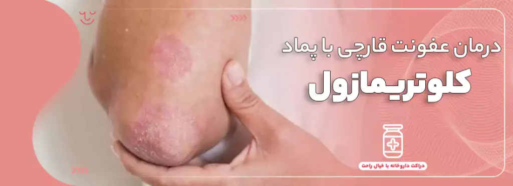درمان عفونت قارچی با پماد کلوتریمازول